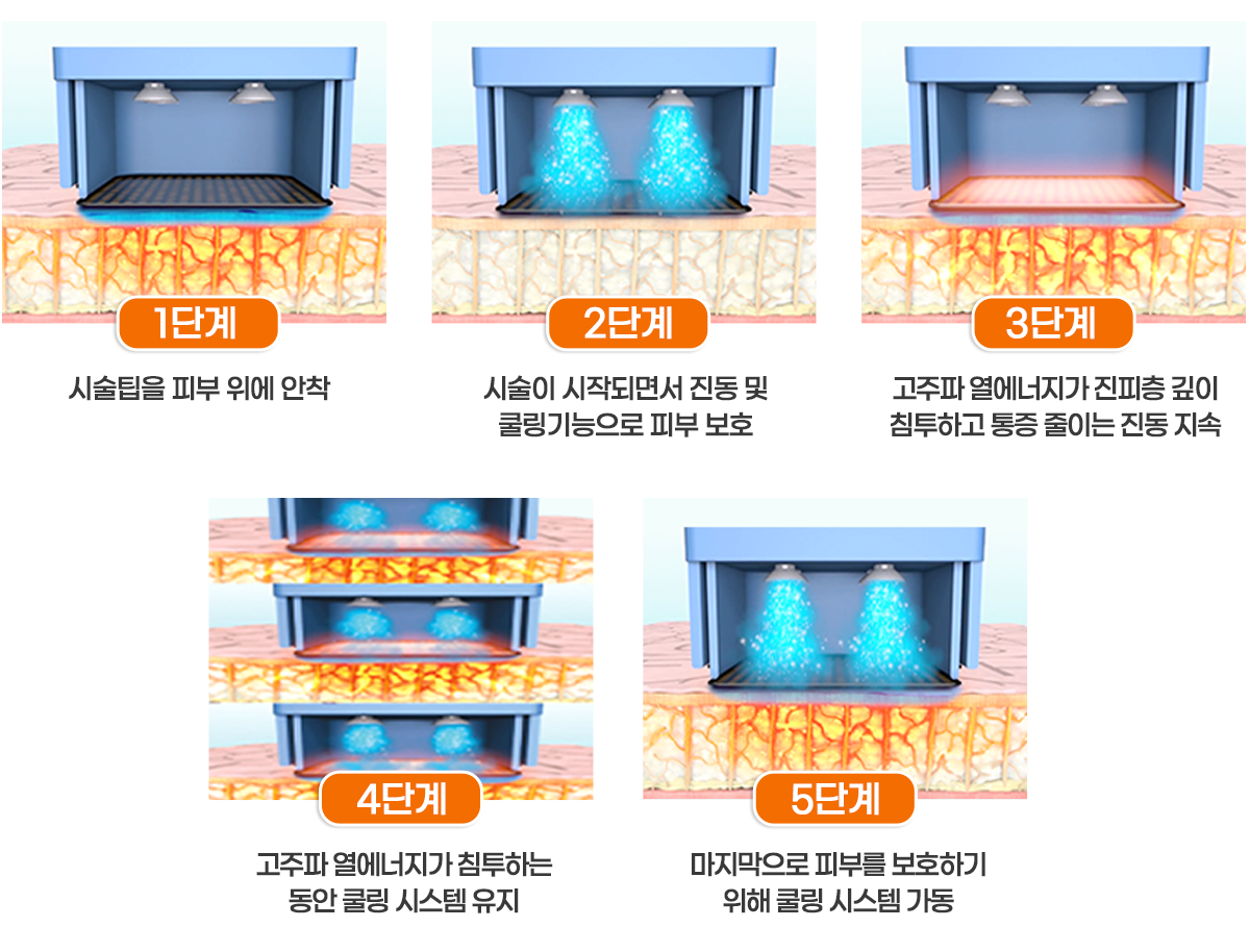 쿨링펄스