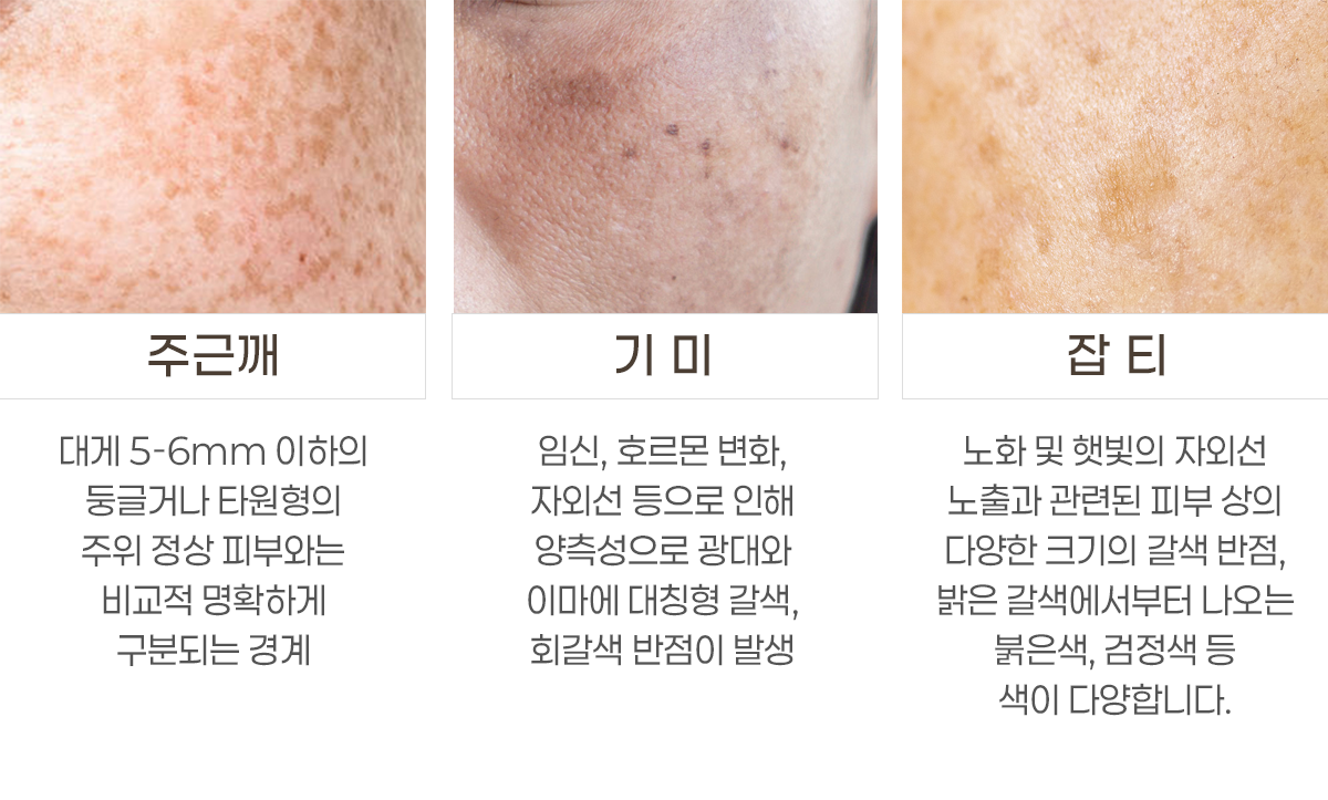 색소성질환